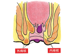 痔のいろいろ